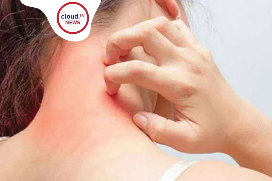 skin disease during winter season