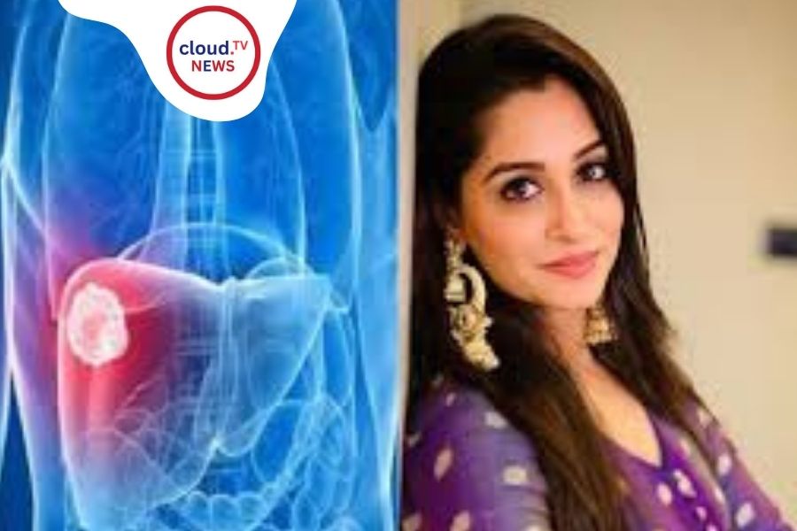 DipikaKakar Lever Cancer: A Fight for Life %%page%% %%sep%% %%sitename%%